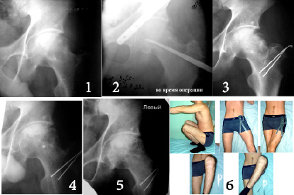 Некроз тазобедренного сустава 3 степени лечение без операции фото